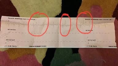 I tried hypnosis to help with my heart anxiety